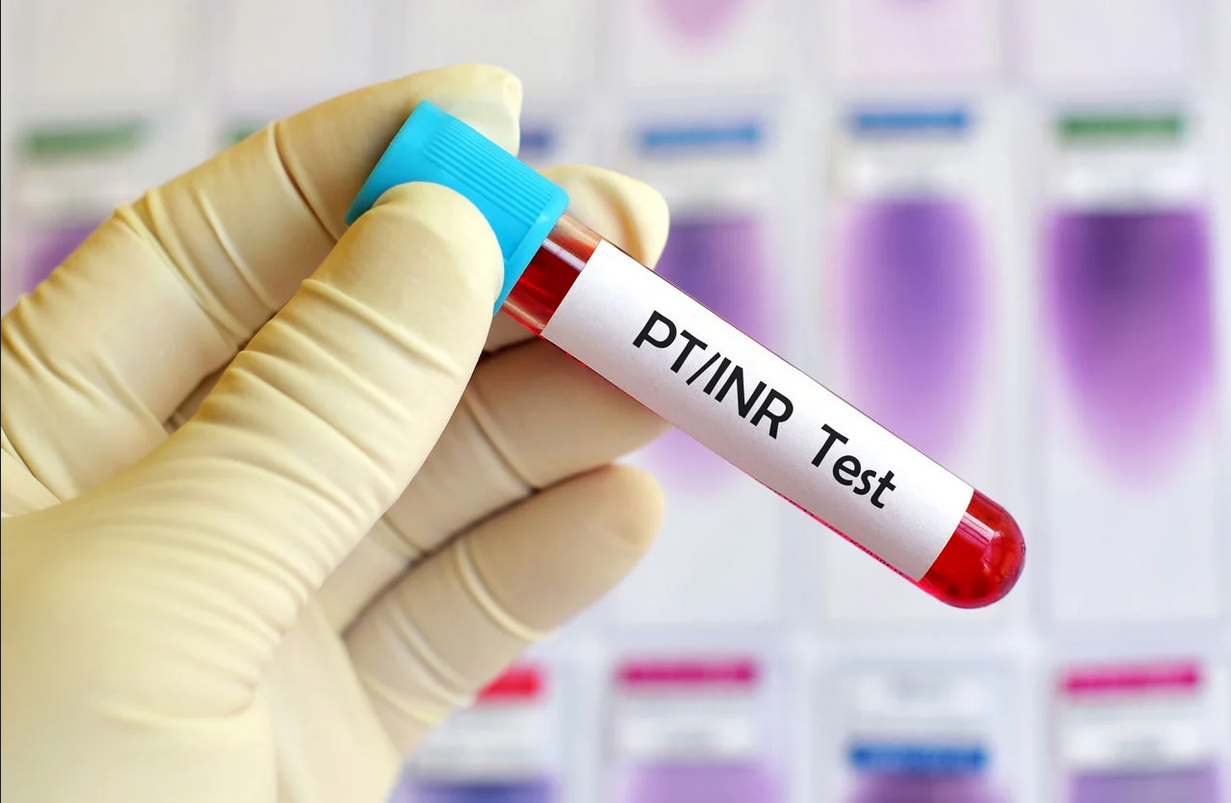 New urine test to detect blood clots